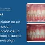 Caso Real: Reposición de un canino con extracción de un premolar tratado con Invisalign