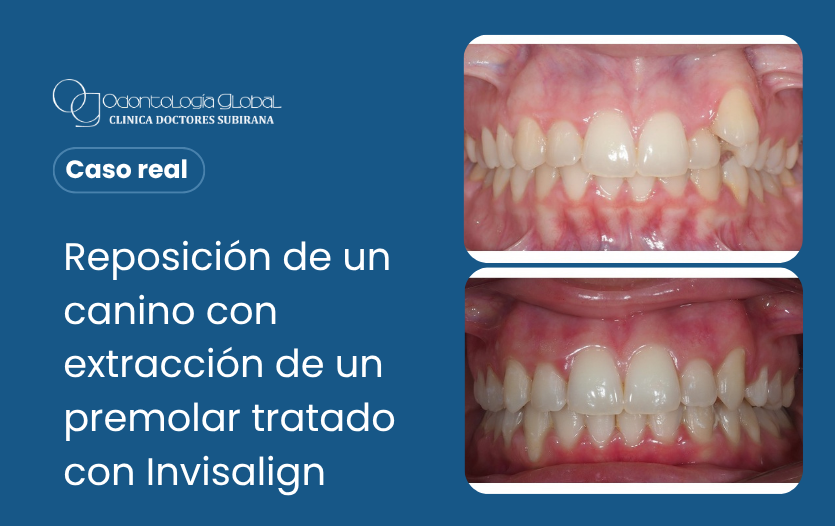 Caso Real: Reposición de un canino con extracción de un premolar tratado con Invisalign