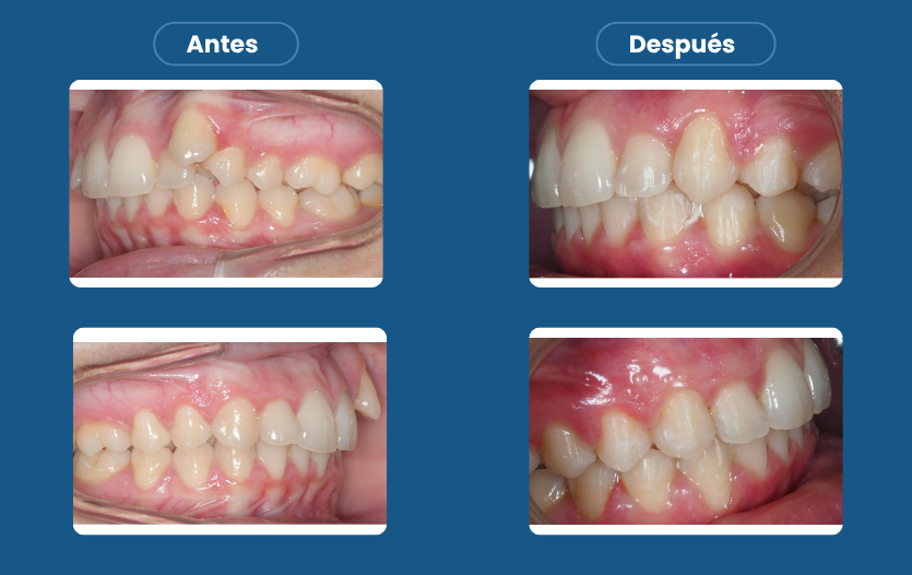 Caso Real: Reposición de un canino con extracción de un premolar tratado con Invisalign